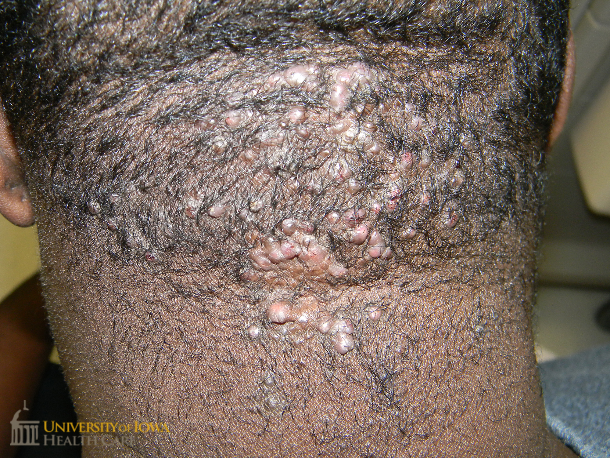 Grouped keloidal papules on the occipital scalp. (click images for higher resolution).